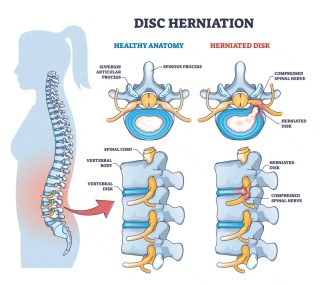 Herniated Disc HealthSpine Chiropractic