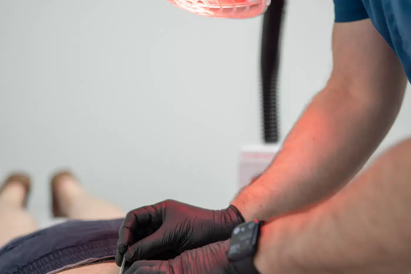 Close view of a gloved hand placing a fine dry needling needle in a patient&rsquo;s lower back at HealthSpine Chiropractic in Carrollwood, Tampa.